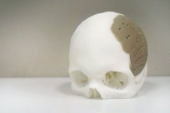 美国OPM公司首创3D打印头骨获FDA批准