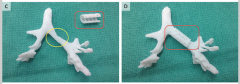 [3D打印案例]3D打印气管夹-支持婴儿气管